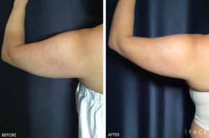 EMSCULPT® Treatments in Oakland County MI | FACE Beauty Science