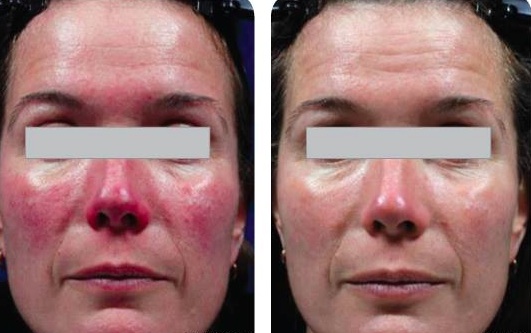 excel® V CoolView Laser Treatments in Oakland County MI | FACE Beauty Science