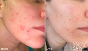 Acne Treatments in Oakland County MI | FACE Beauty Science