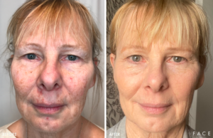 Hyperpigmentation & Melasma Treatments in Oakland County MI | FACE Beauty Science