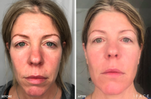 MicroLaserPeel Results Oakland County MI | FACE Beauty Science