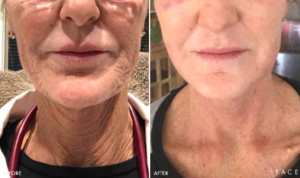 Anti-Aging Results Oakland County MI | FACE Beauty Science