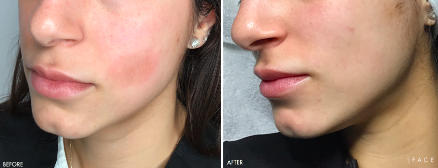 Hyperpigmentation & Melasma Treatments in Oakland County MI | FACE Beauty Science