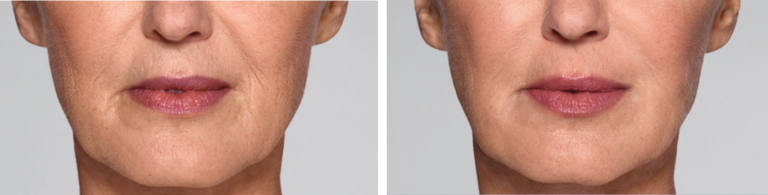 Restylane® Refyne Injectable Filler | Oakland County MI | FACE Beauty Science