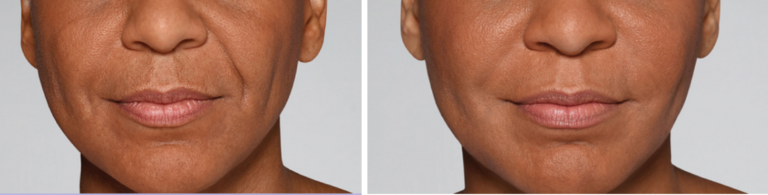 Restylane® Refyne Injectable Filler | Oakland County MI | FACE Beauty Science