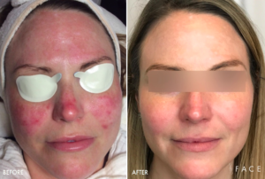 Rosacea Treatment Oakland County MI | FACE Beauty Science