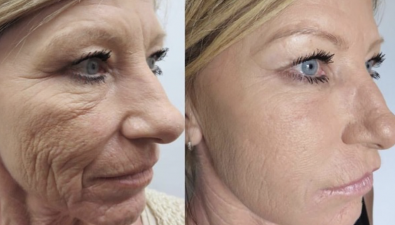 Plasma Facelift with Injectable PRP Treatments in Oakland County MI | FACE Beauty Science