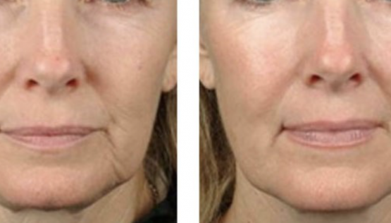 Plasma Facelift with Injectable PRP Treatments in Oakland County MI | FACE Beauty Science