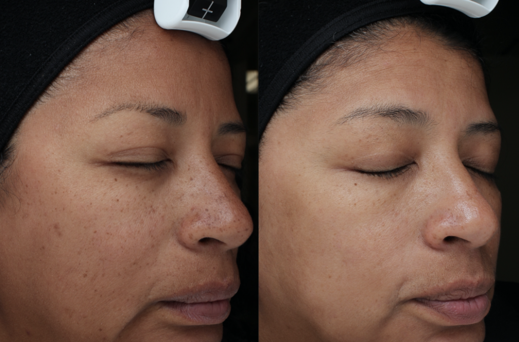 Moxi Laser Treatments in Oakland County MI FACE Beauty Science Face