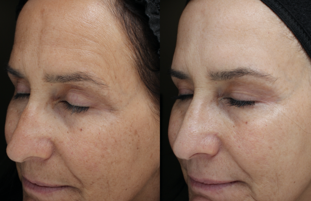 Moxi Laser Treatments in Oakland County MI FACE Beauty Science Face