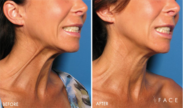 Neck Rejuvenation Birmingham Chest Wrinkle Treatment Bloomfield Hills