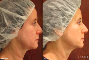 Elasticity Treatments in Oakland County MI | FACE Beauty Science