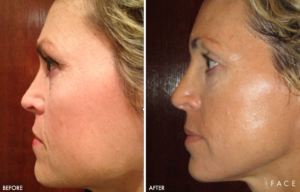 Elasticity Treatments in Oakland County MI | FACE Beauty Science
