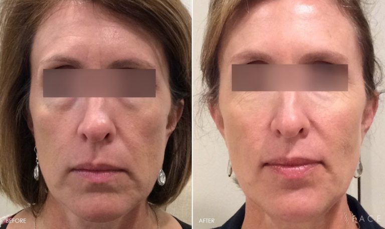 AGING AND WRINKLES Treatments in Oakland County MI | FACE Beauty Science