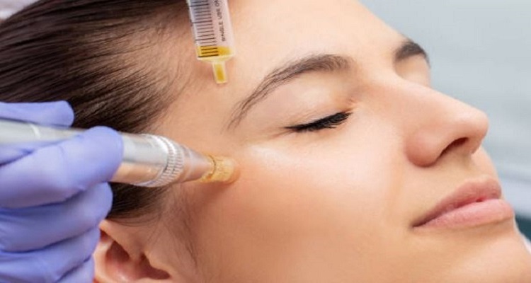 Microneedling Birmingham