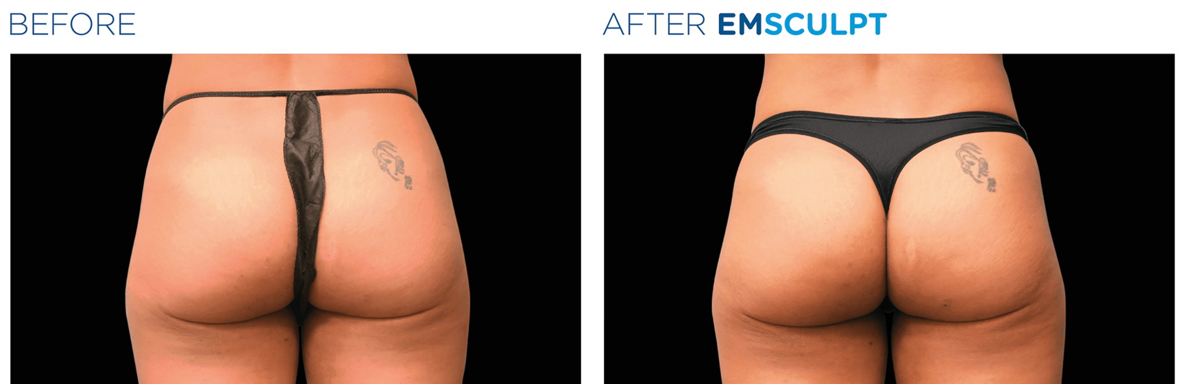 emsculpt before and after1