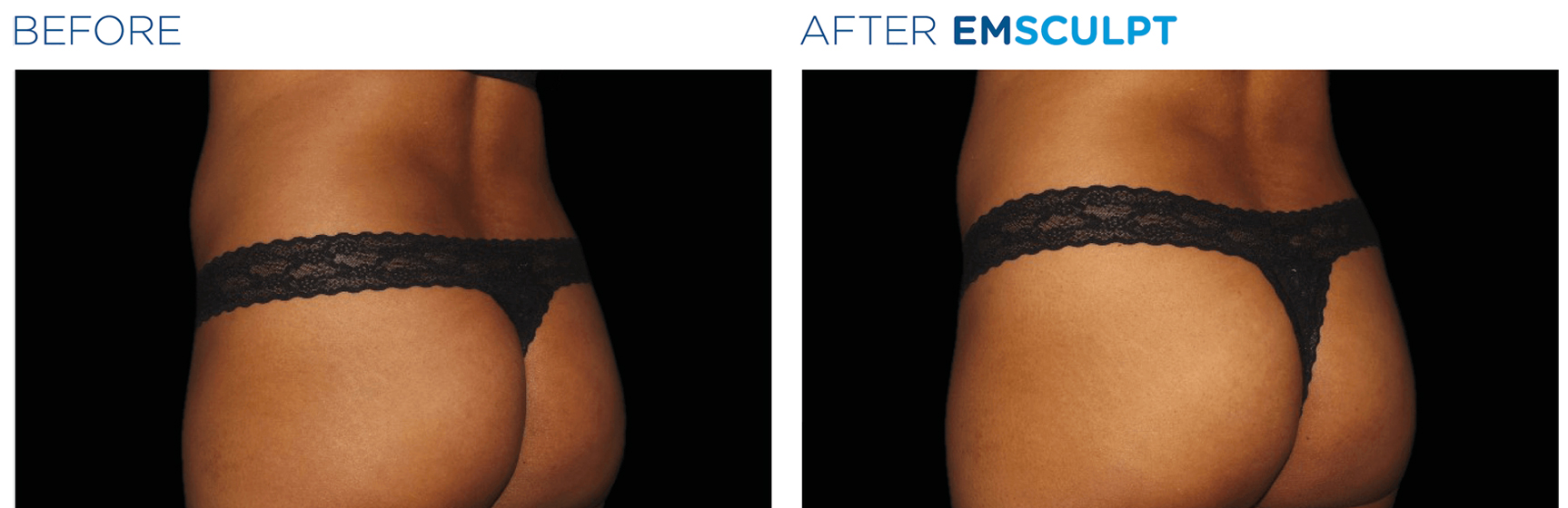 emsculpt before and after