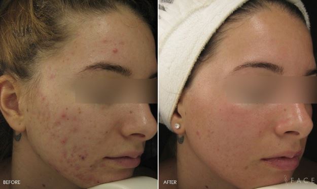 microneedling ogden