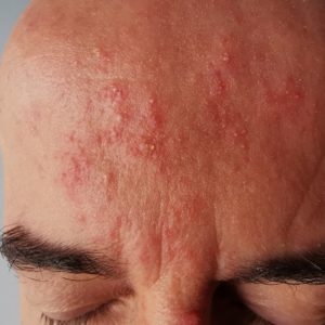 Rosacea treatment Birmingham