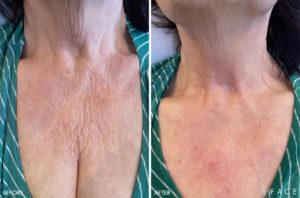 Biorevitalization Peel Before and After Bloomfield