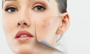 Birmingham Chemical Peels