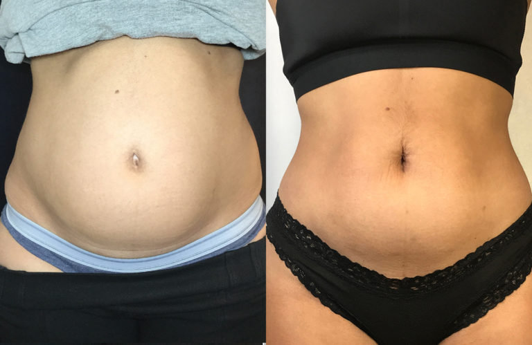 What is EMSculpt? Non-Surgical Body-Sculpting and Muscle Toning