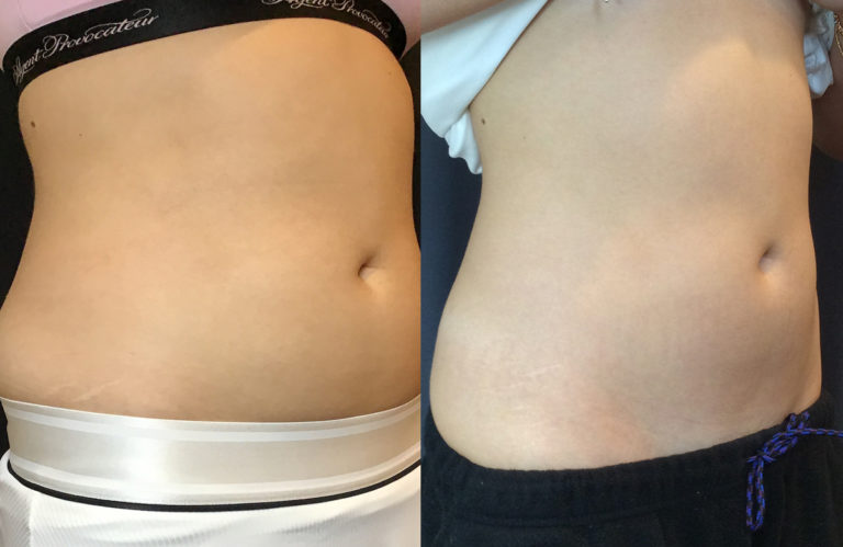 EMSCULPT NEO® Birmingham, Body Sculpting Bloomfield Hills