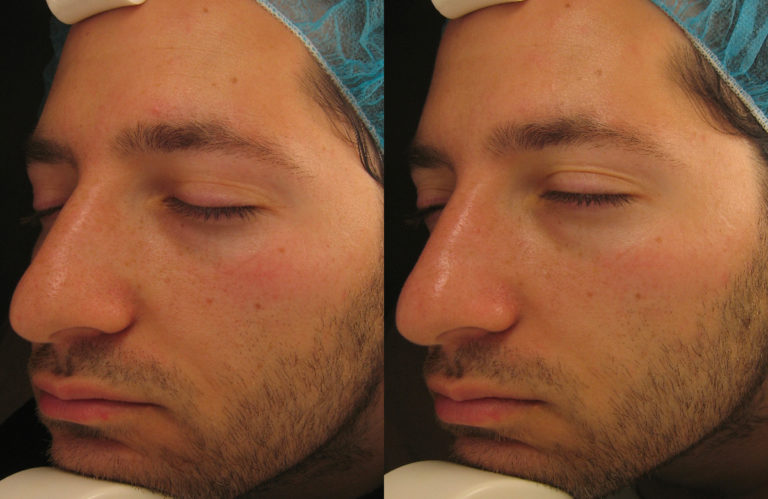 24891_Julian-B_Hydrafacial