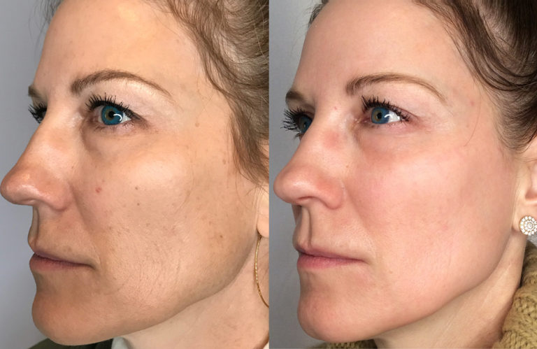 Lumenis UltraPulse® CO2 Fractional Laser Skin Resurfacing Natick