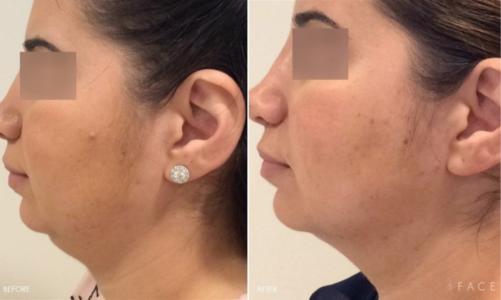 b & a Kybella Birmingham