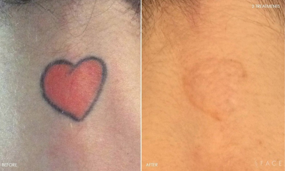 b & a Laser Tattoo Removal Bloomfield Hills