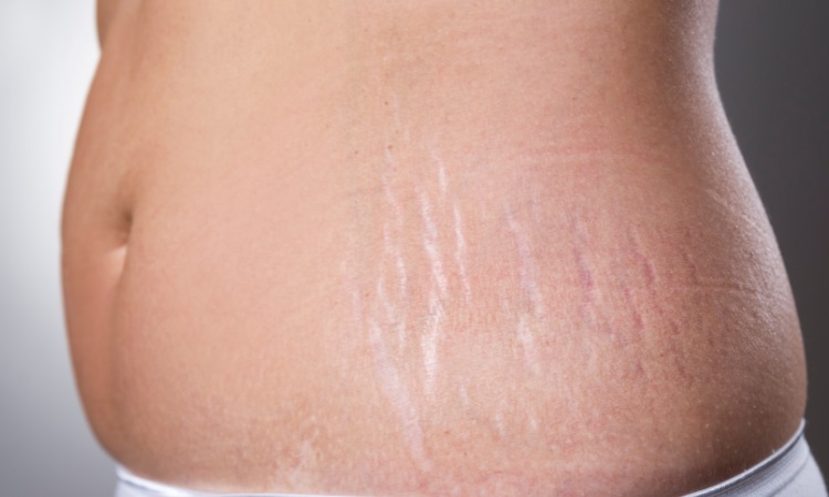 Stretch Mark Treatment Bloomfield Hills