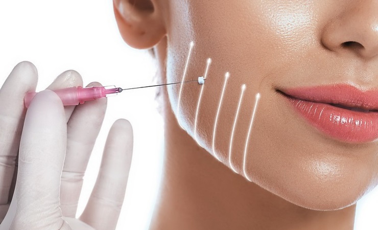How Much Can a Thread Lift Cost? | Thread Lift Bloomfield Hills | Face  Beauty Science