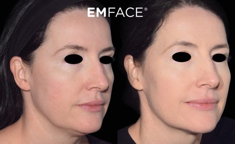 Emface™ Birmingham Bloomfield Hills