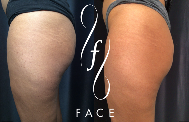 Before and After photo of improved legs after a Morpheus8 Treatment.