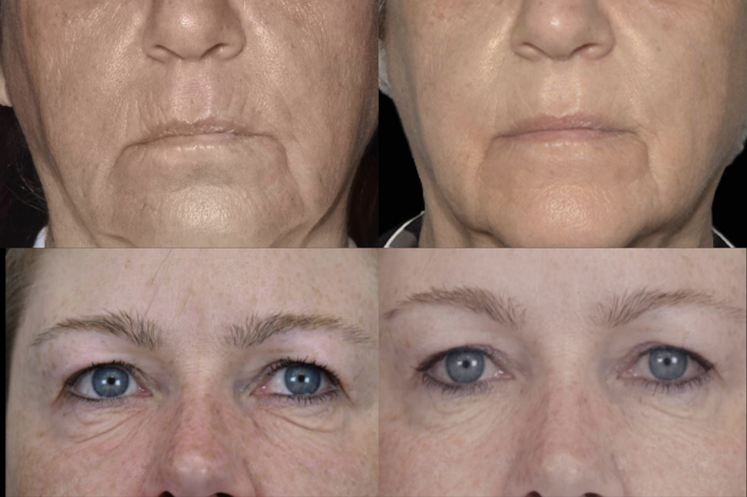 Exion Face | Before and After at FACE Medspa in Bloomfield Hills, Michigan