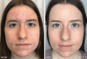 Acne Treatments in Oakland County MI | FACE Beauty Science