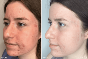 Acne Treatments in Oakland County MI | FACE Beauty Science