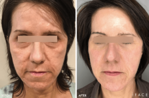 Anti-Aging Results Oakland County MI | FACE Beauty Science