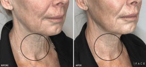 Elasticity Treatments in Oakland County MI | FACE Beauty Science