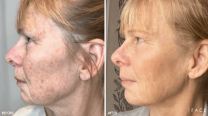 Hyperpigmentation & Melasma Treatments in Oakland County MI | FACE Beauty Science