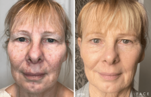 Anti-Aging Results Oakland County MI | FACE Beauty Science