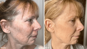 Hyperpigmentation & Melasma Treatments in Oakland County MI | FACE Beauty Science