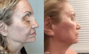 ProFractional™ Treatments in Oakland County MI | FACE Beauty Science
