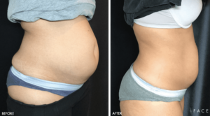 Trusculpt Treatments in Oakland County MI | FACE Beauty Science