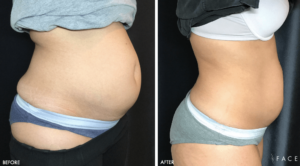 Trusculpt Treatments in Oakland County MI | FACE Beauty Science