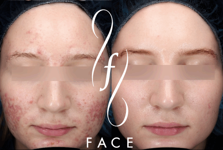 A. Pratt - Pearl (acne)
