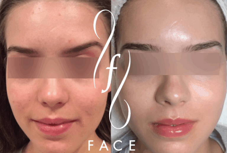 CELEB FACIAL