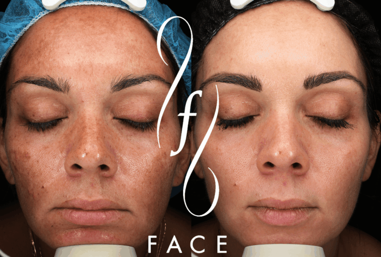 ENLIGHTEN PEEL