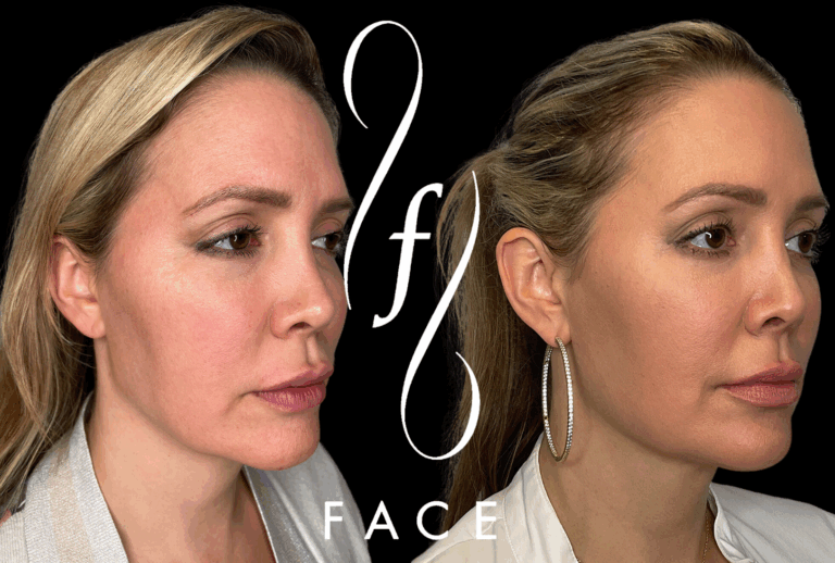 HOLLY EMFACE